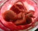 feto intrautero