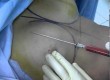 mama tuberosa - lipofilling vs implantes