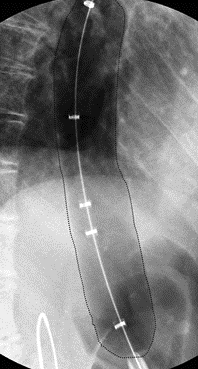 dilatacion-acalasia