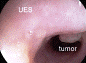 tumor-esofago