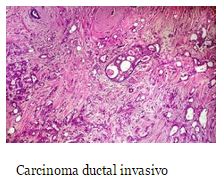 Carcinoma ductal invasivo