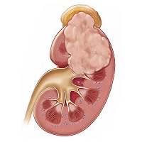 tumor de riñón