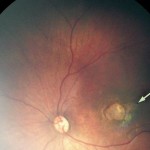 Zika virus in Brazil and macular atrophy in a child with microcephaly