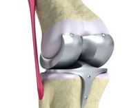 prótesis de rodilla